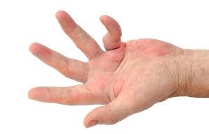 Dupuytren's Contracture
