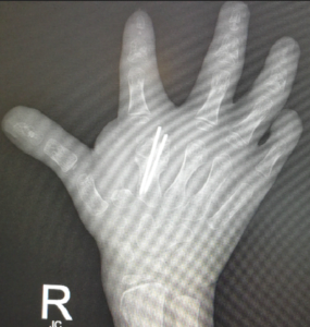 conginental hand deformity 2