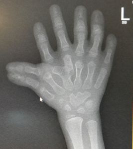 conginental hand deformity 1