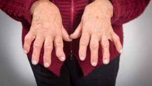 Blog 21 rheumatoid arthritis vs osteoarthritis