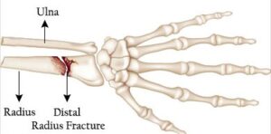 Distale Radius All About Distal Radius Fracture - Prof Dr Robert Hierner