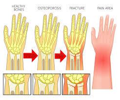 Osteoporosis in hand