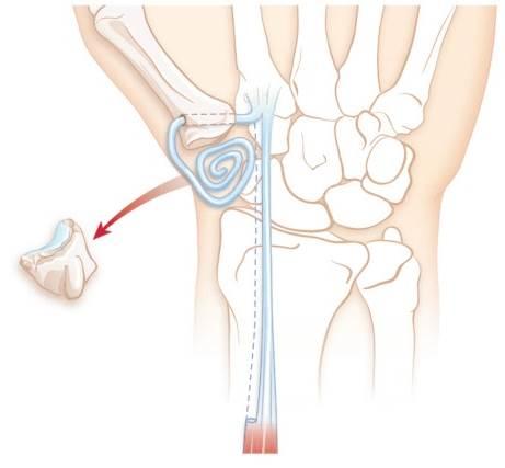 surgical treatment for joint changes