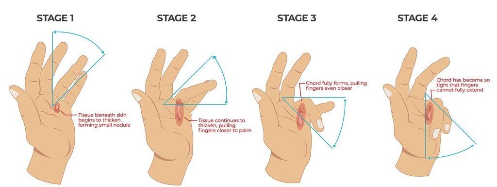 all you need to know about dupuytrens contracture