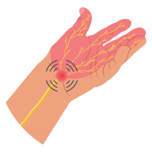 treatment for carpal tunnel syndrome