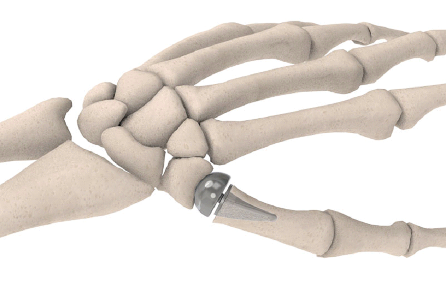 hand joint replacement surgery in Dubai
